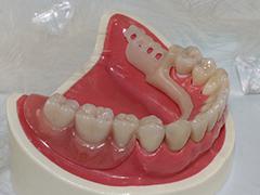 牙齿矫正后的注意事项